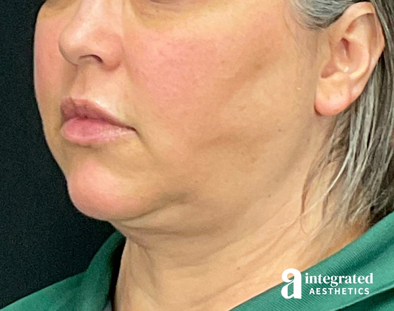FaceTite & AccuTite Before & After Gallery - Patient 133213732 - Image 4