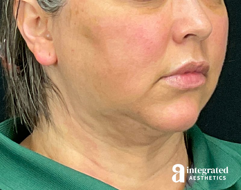 FaceTite & AccuTite Before & After Gallery - Patient 133213732 - Image 6