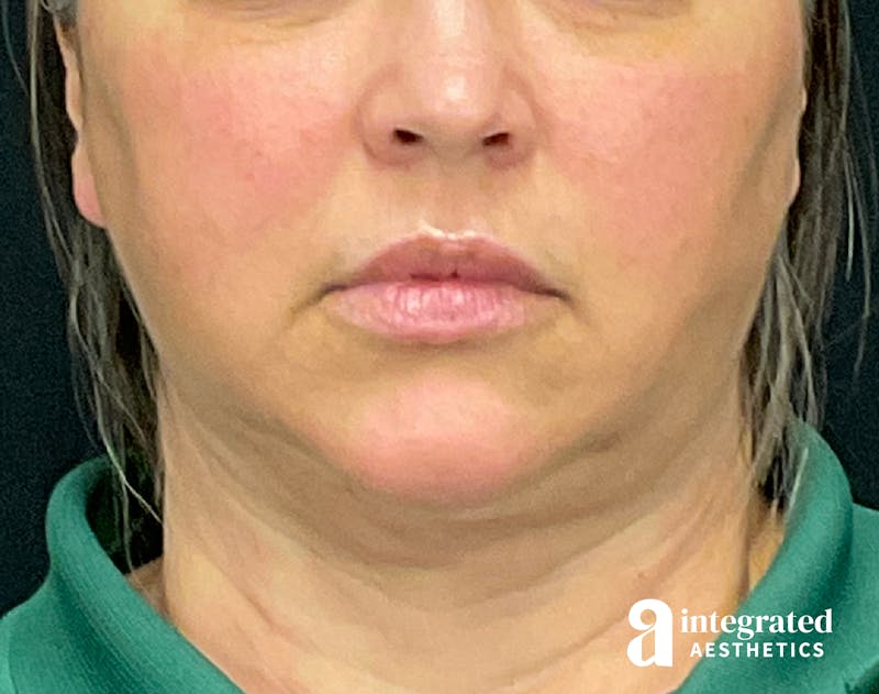 FaceTite & AccuTite Before & After Gallery - Patient 133213732 - Image 2