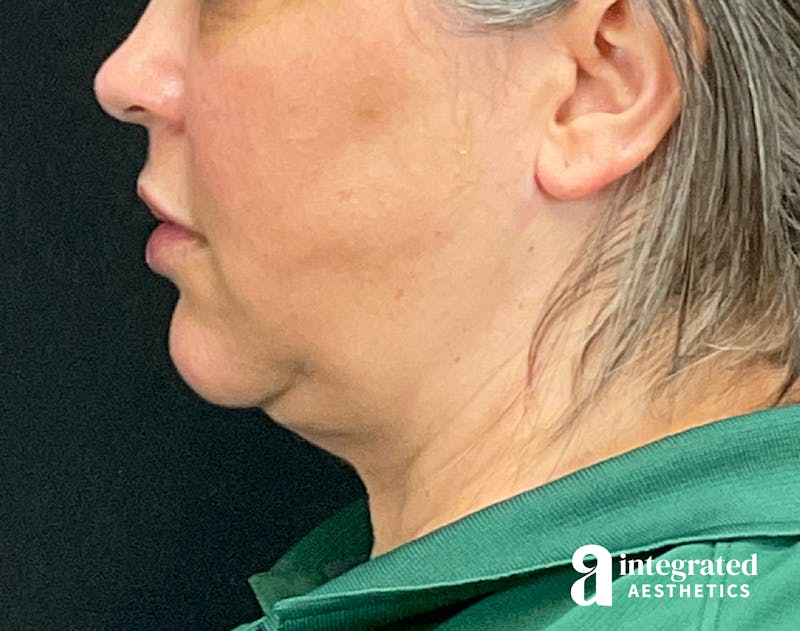 FaceTite & AccuTite Before & After Gallery - Patient 133213732 - Image 8