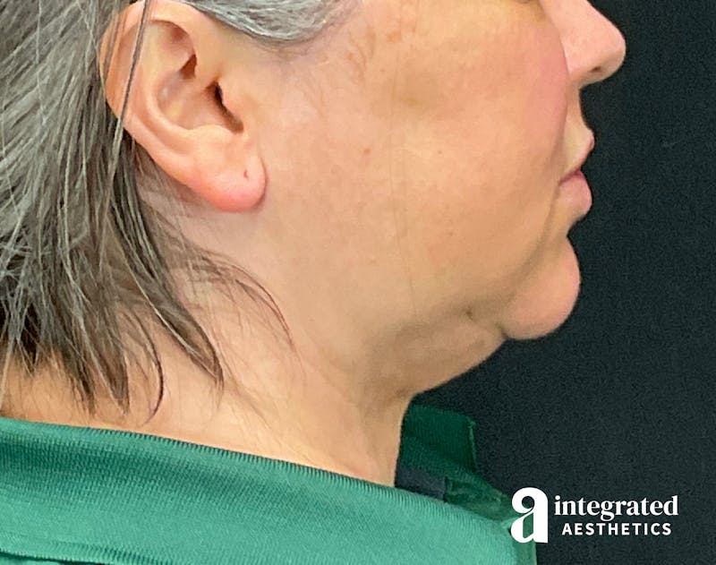 FaceTite & AccuTite Before & After Gallery - Patient 133213732 - Image 10