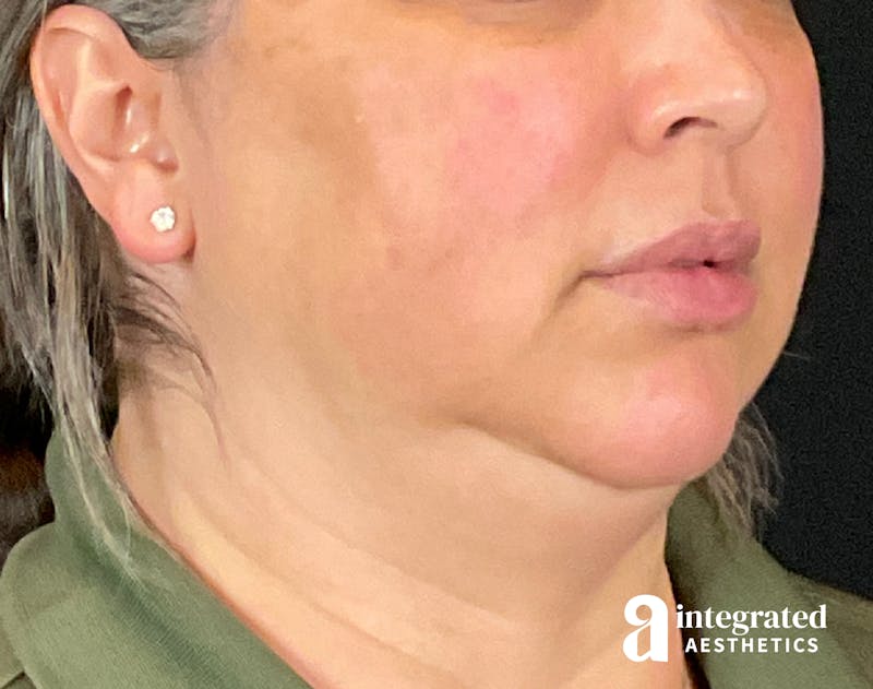 FaceTite & AccuTite Before & After Gallery - Patient 133213732 - Image 5