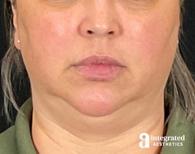 FaceTite & AccuTite Before & After Gallery - Patient 133213732 - Image 1