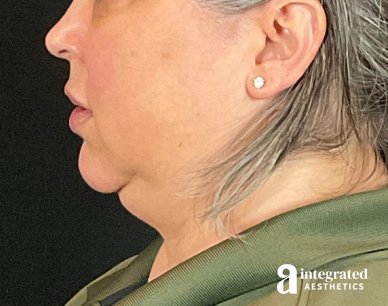 FaceTite & AccuTite Before & After Gallery - Patient 133213732 - Image 7