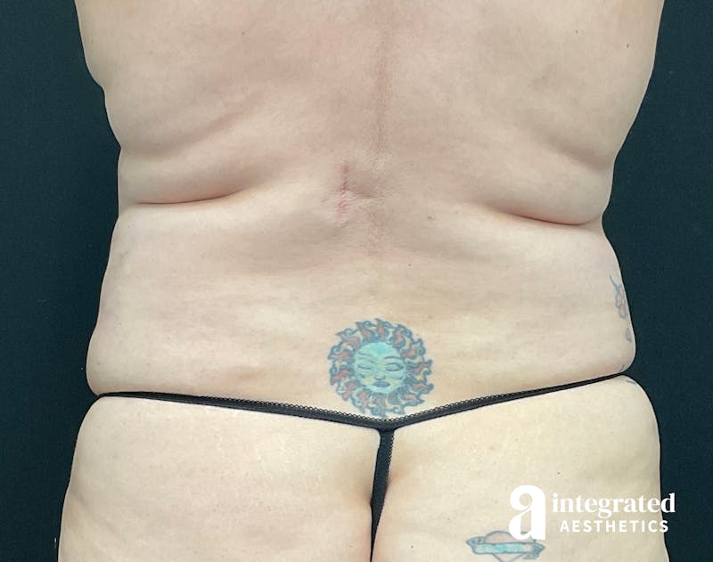 BodyTite Before & After Gallery - Patient 133213746 - Image 8