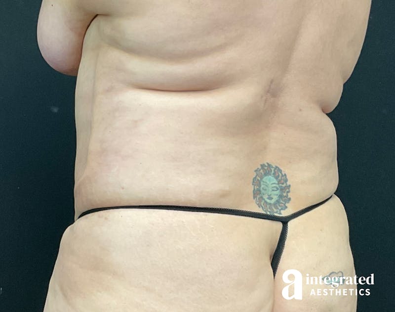 BodyTite Before & After Gallery - Patient 133213746 - Image 10