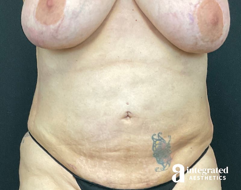 BodyTite Before & After Gallery - Patient 133213746 - Image 2