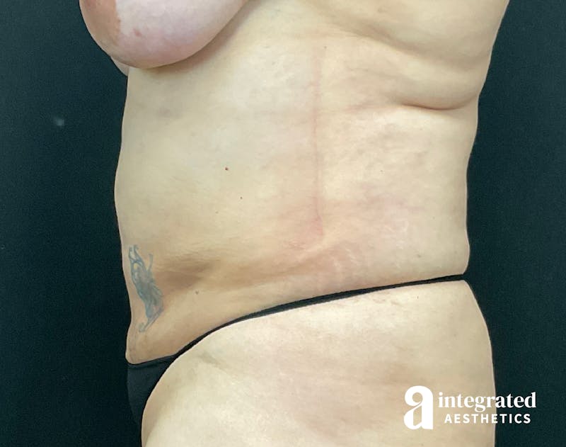 BodyTite Before & After Gallery - Patient 133213746 - Image 14