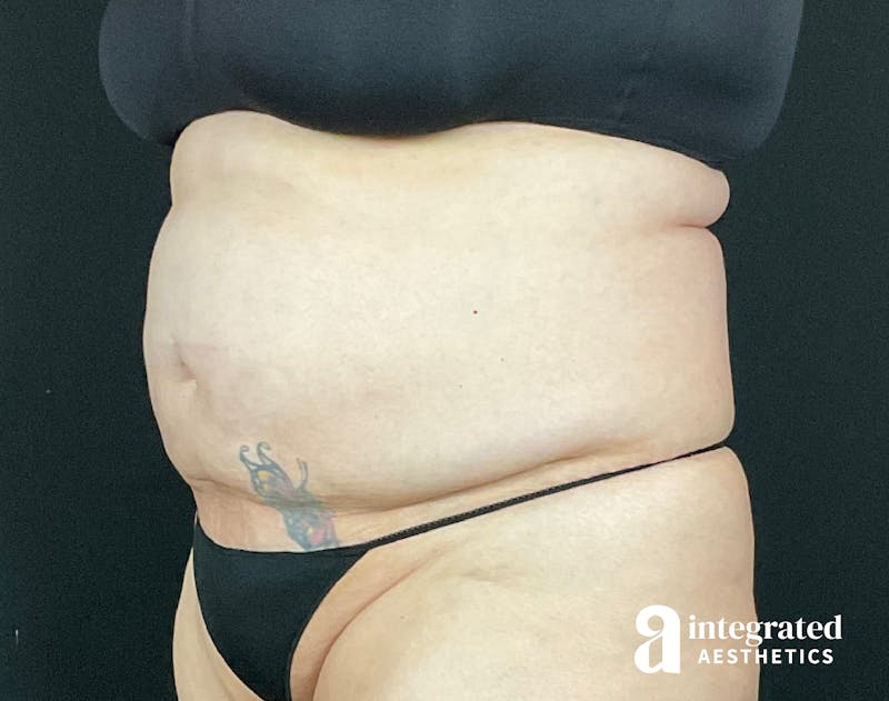 BodyTite Before & After Gallery - Patient 133213746 - Image 3