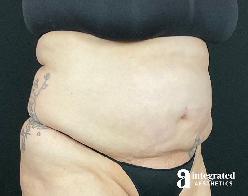 BodyTite Before & After Gallery - Patient 133213746 - Image 5