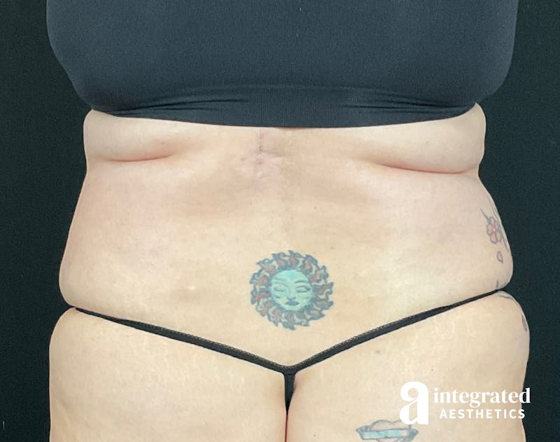 BodyTite Before & After Gallery - Patient 133213746 - Image 7