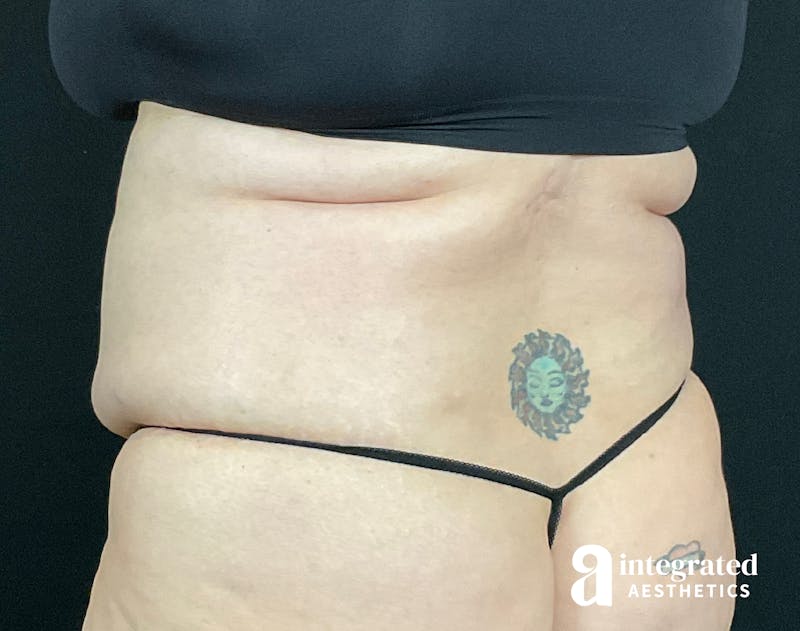 BodyTite Before & After Gallery - Patient 133213746 - Image 9