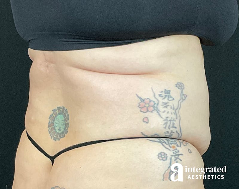 BodyTite Before & After Gallery - Patient 133213746 - Image 11