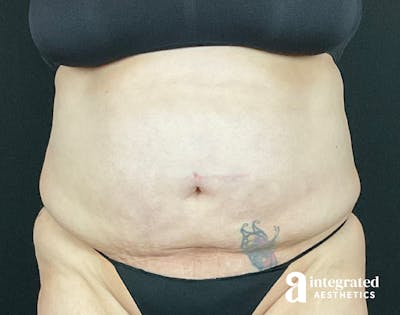 BodyTite Before & After Gallery - Patient 133213746 - Image 1