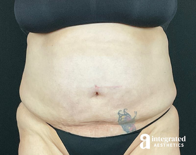 BodyTite Before & After Gallery - Patient 133213746 - Image 1