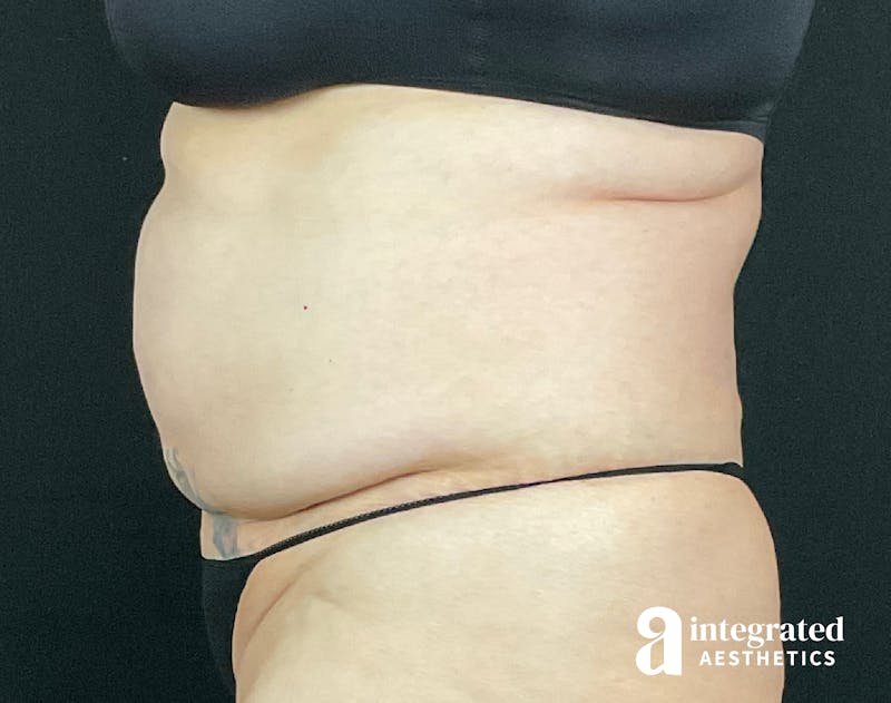 BodyTite Before & After Gallery - Patient 133213746 - Image 13