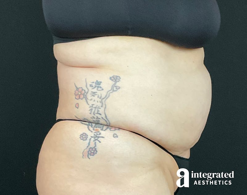 BodyTite Before & After Gallery - Patient 133213746 - Image 15