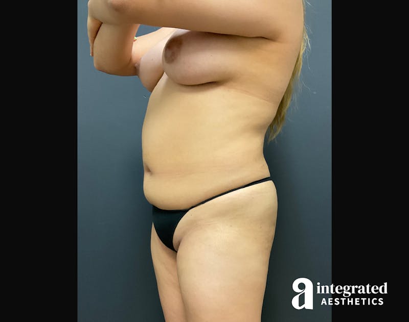 BodyTite Before & After Gallery - Patient 133213766 - Image 3
