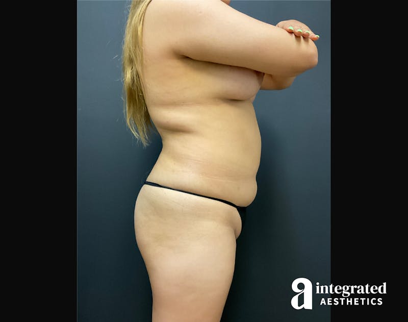 BodyTite Before & After Gallery - Patient 133213766 - Image 9