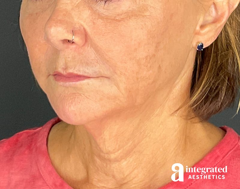 Sculptra Before & After Gallery - Patient 148564291 - Image 8