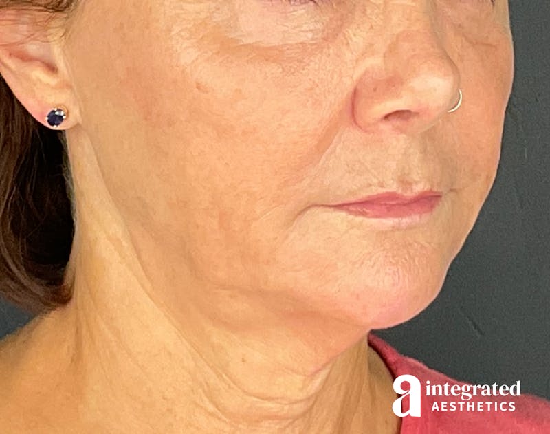 Sculptra Before & After Gallery - Patient 148564291 - Image 4