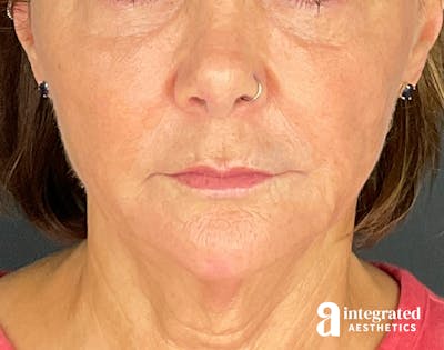 Lip Filler Before & After Gallery - Patient 148574556 - Image 2