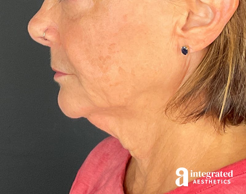 Dermal Fillers Before & After Gallery - Patient 148573831 - Image 10