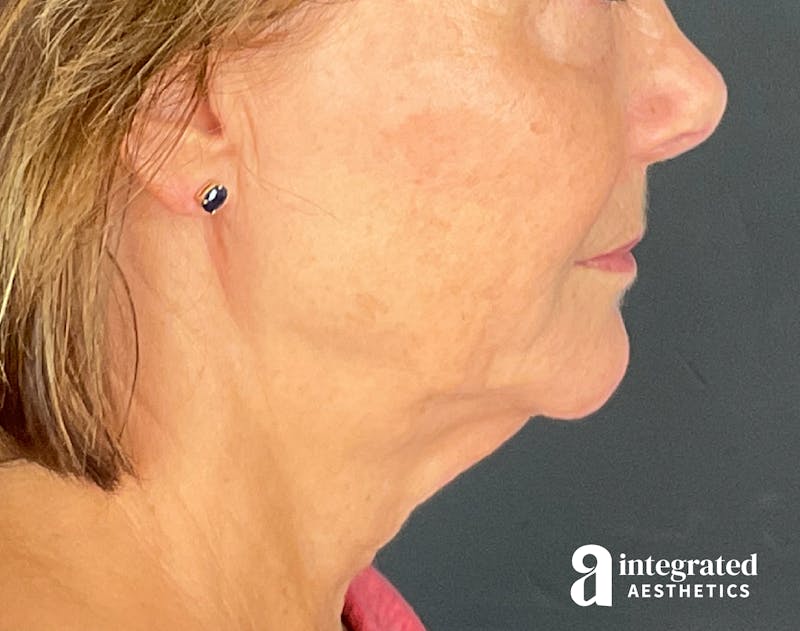 Sculptra Before & After Gallery - Patient 148564291 - Image 6