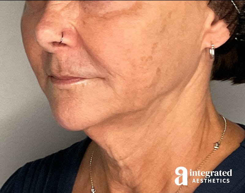Lip Filler Before & After Gallery - Patient 148574556 - Image 7