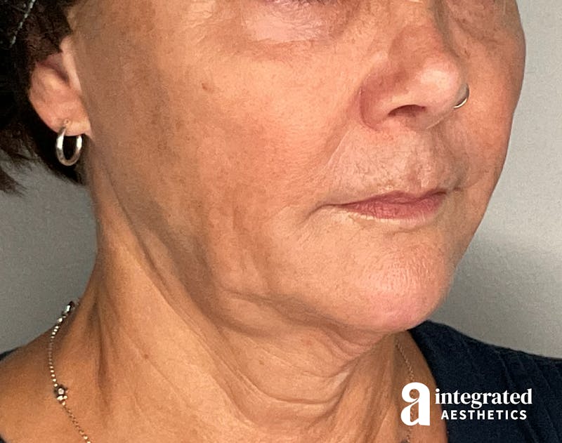 Dermal Fillers Before & After Gallery - Patient 148573831 - Image 3