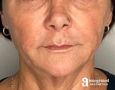 Sculptra Before & After Gallery - Patient 148564291 - Image 1