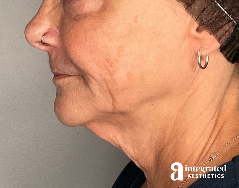 Sculptra Before & After Gallery - Patient 148564291 - Image 9