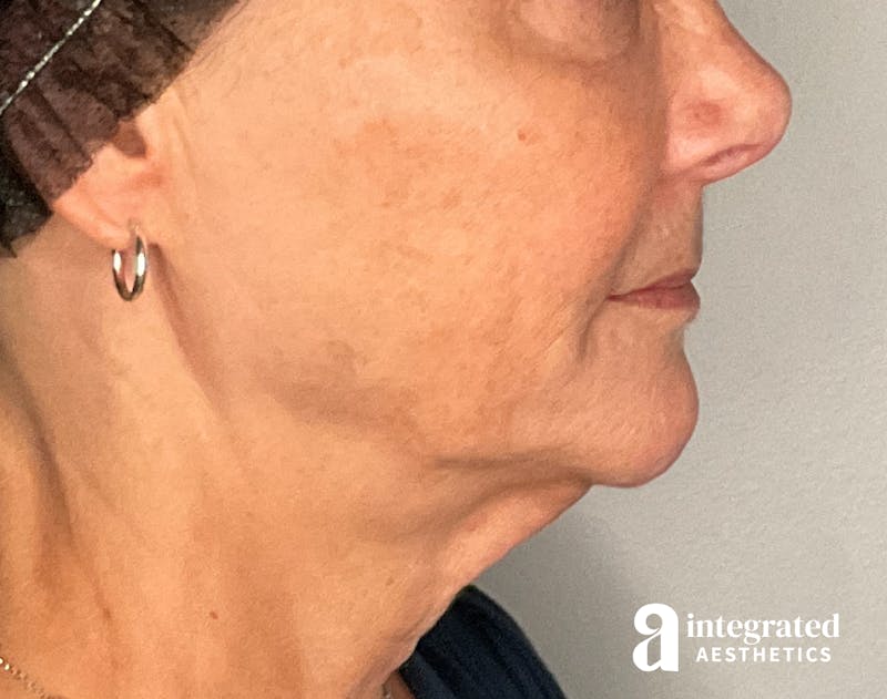Sculptra Before & After Gallery - Patient 148564291 - Image 5