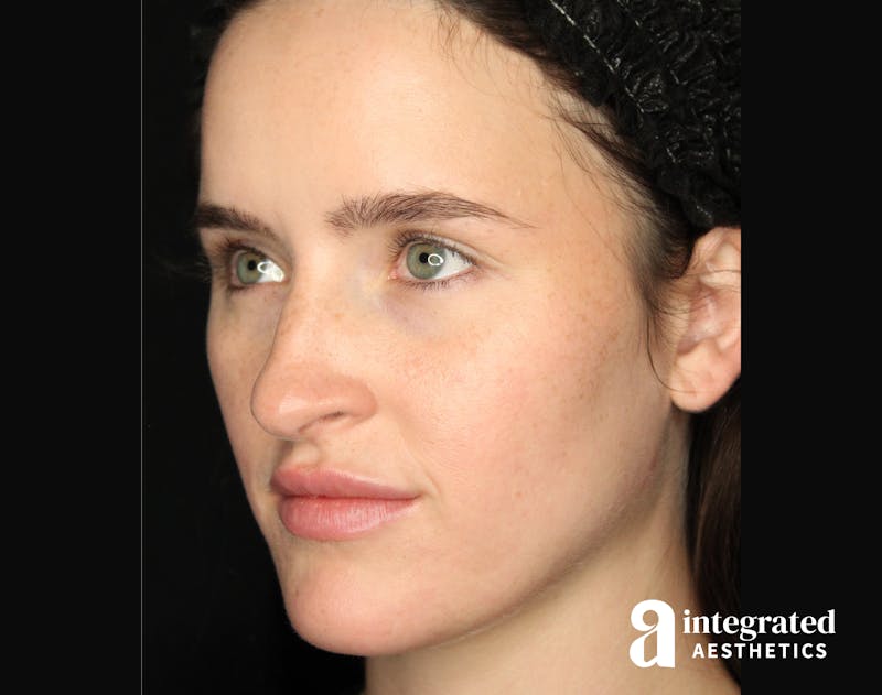 Sculptra Before & After Gallery - Patient 148564567 - Image 2