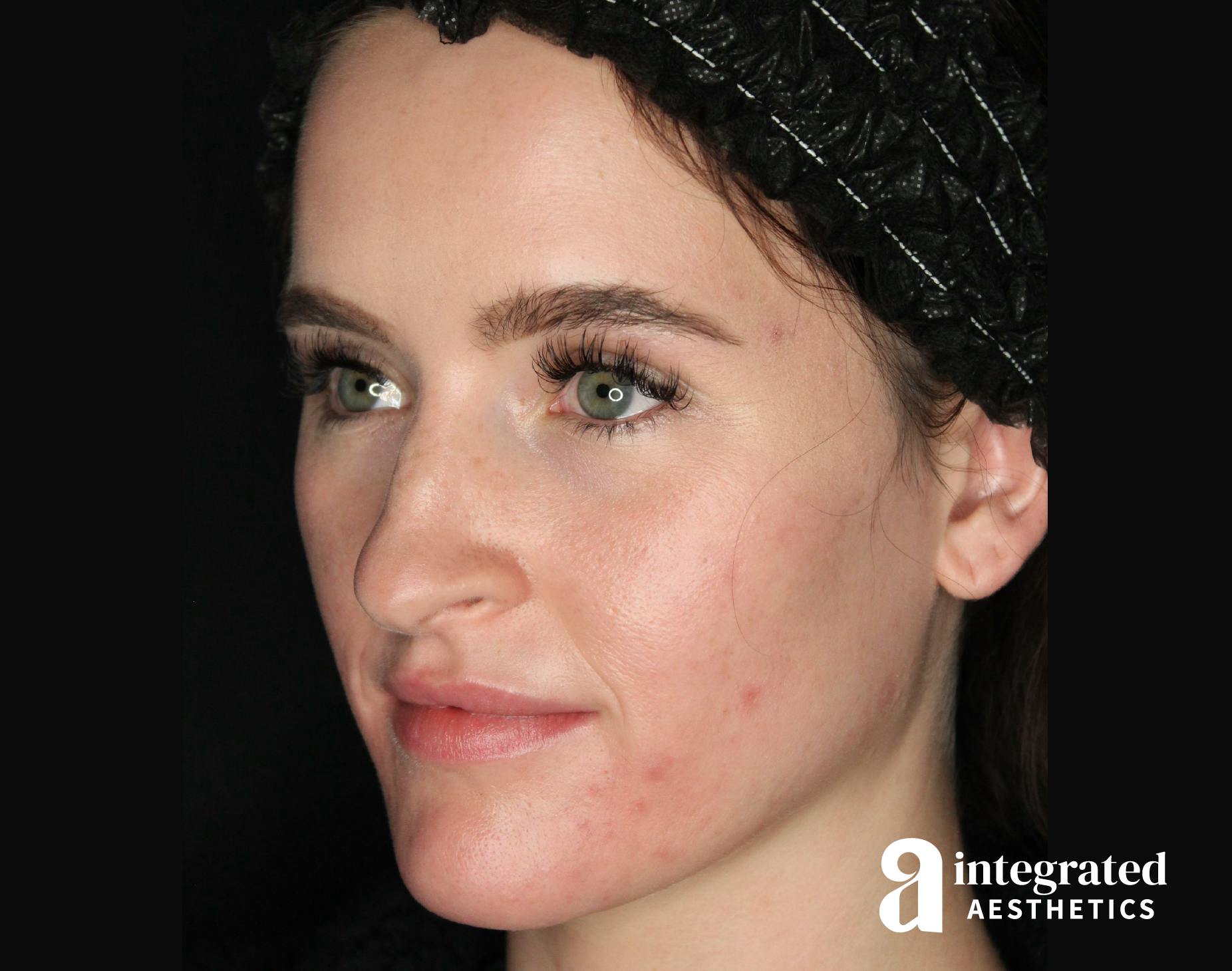 Before & after Accutane treatment with Integrated Aesthetics