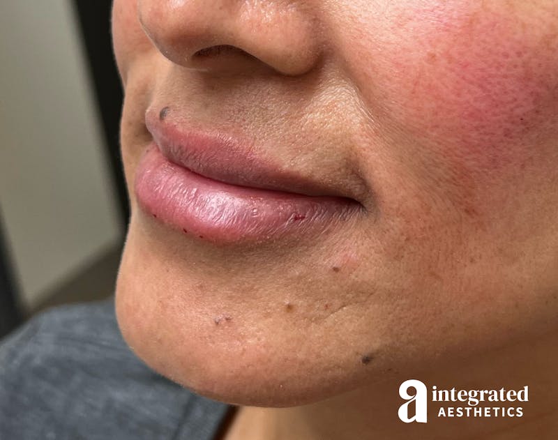 Lip Filler Before & After Gallery - Patient 148574592 - Image 6