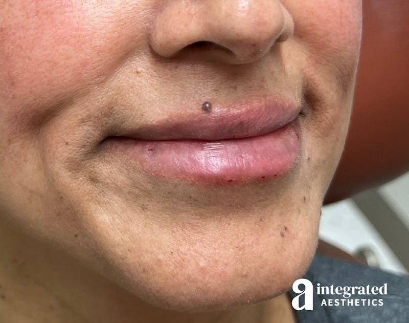 Lip Filler Before & After Gallery - Patient 148574592 - Image 4