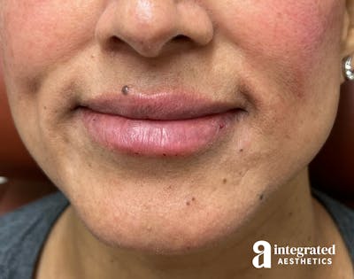 Dermal Fillers Before & After Gallery - Patient 148573676 - Image 2