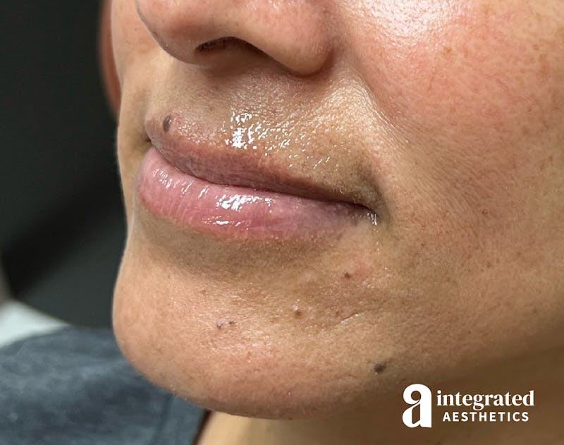 Lip Filler Before & After Gallery - Patient 148574592 - Image 5