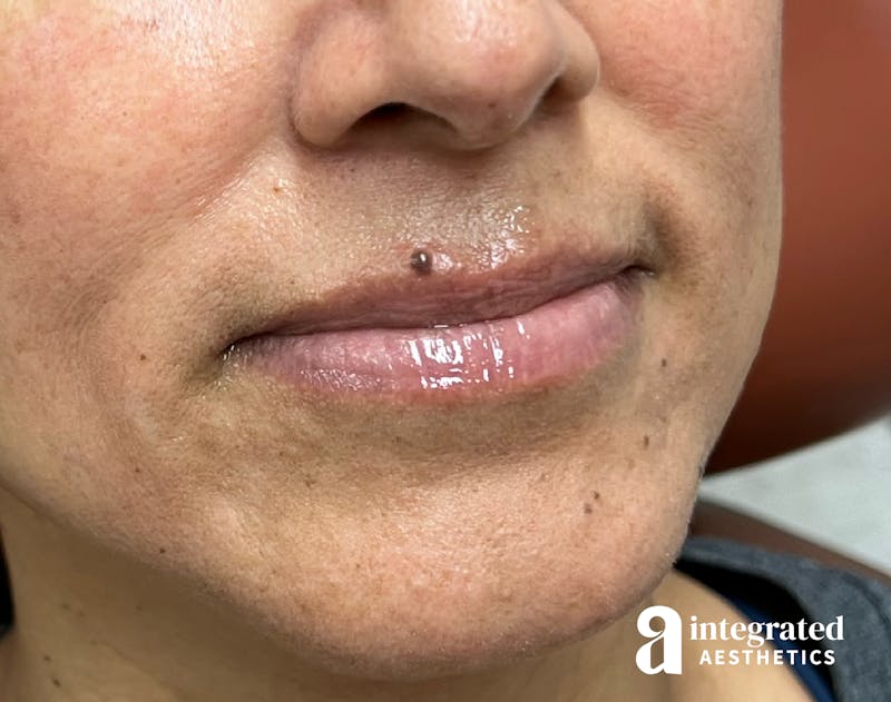 Lip Filler Before & After Gallery - Patient 148574592 - Image 3