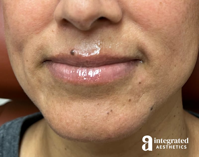 Lip Filler Before & After Gallery - Patient 148574592 - Image 1
