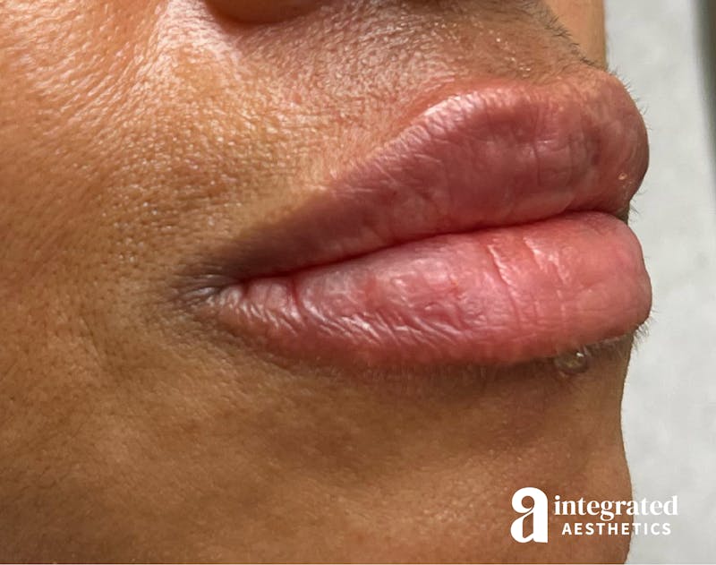 Lip Filler Before & After Gallery - Patient 148574578 - Image 4