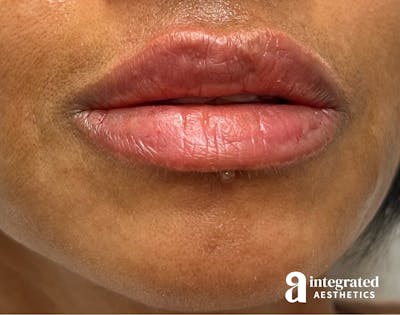 Dermal Fillers Before & After Gallery - Patient 148573832 - Image 2