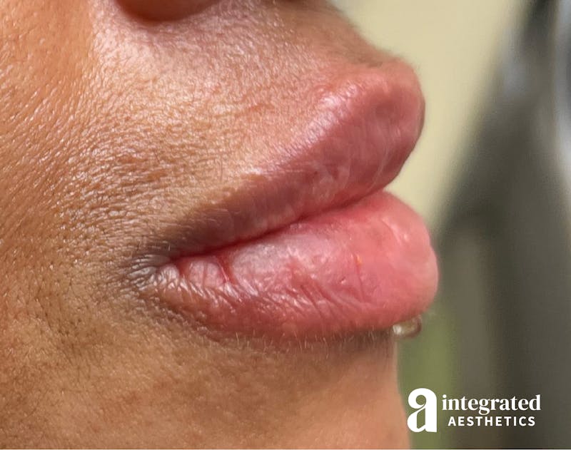 Dermal Fillers Before & After Gallery - Patient 148573832 - Image 6