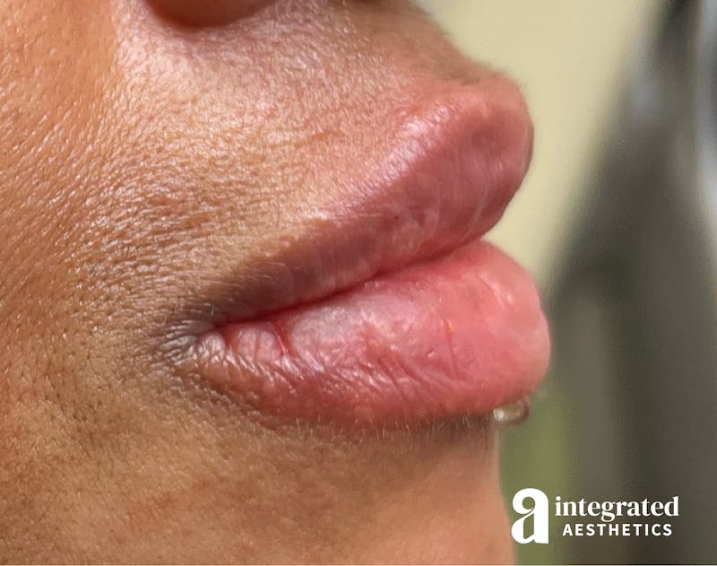 Lip Filler Before & After Gallery - Patient 148574578 - Image 6