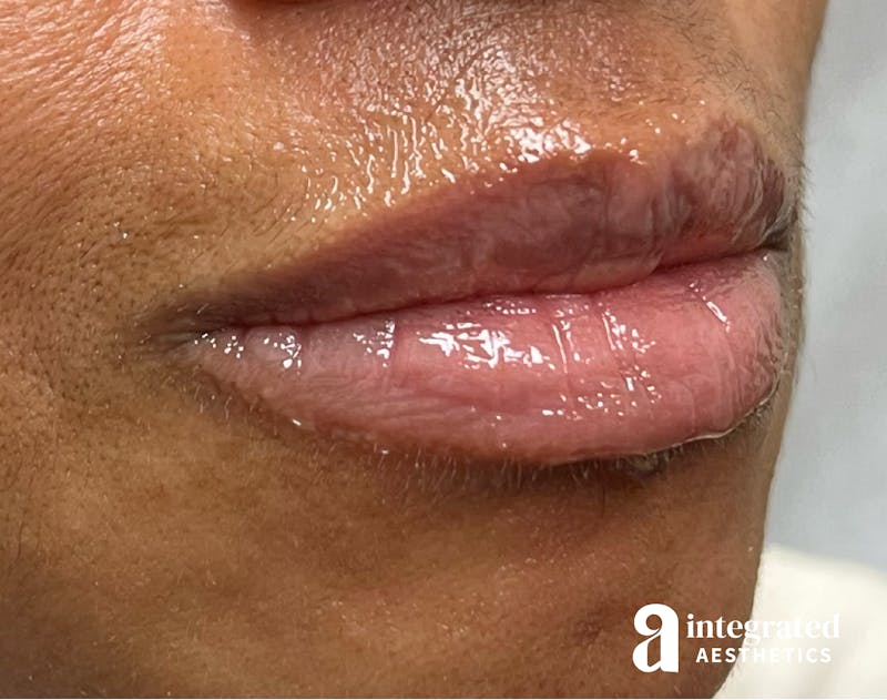 Lip Filler Before & After Gallery - Patient 148574578 - Image 3