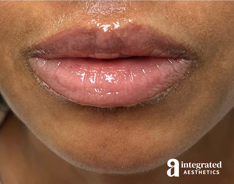 Dermal Fillers Before & After Gallery - Patient 148573832 - Image 1