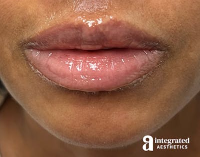 Lip Filler Before & After Gallery - Patient 148574578 - Image 1