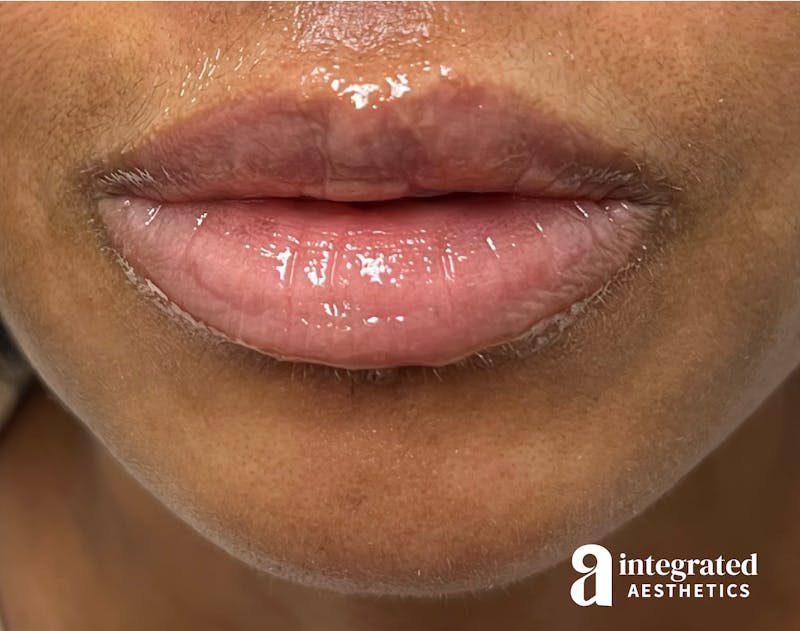 Lip Filler Before & After Gallery - Patient 148574578 - Image 1