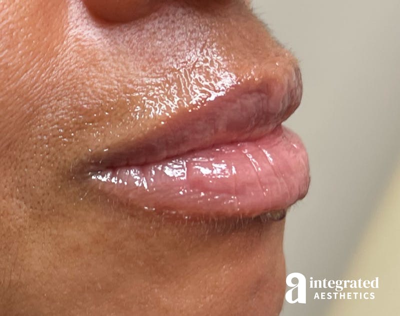 Lip Filler Before & After Gallery - Patient 148574578 - Image 5